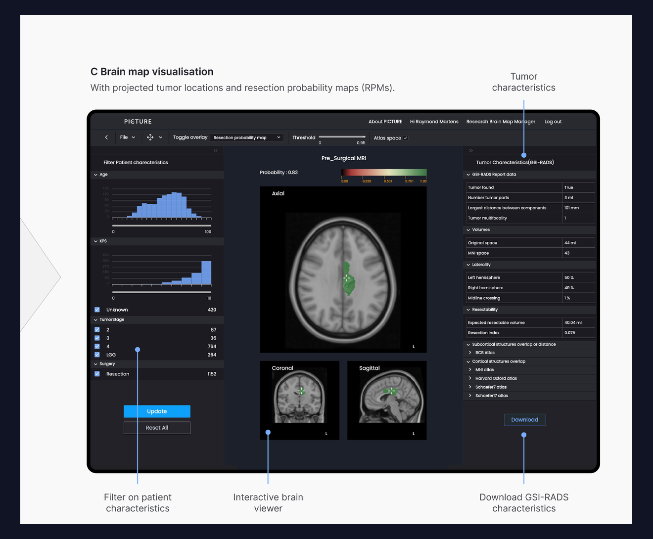 PICTURE-interface met MRI, tumorsegmentatie, resection probability map, patiëntfilters en tumorkarakteristieken