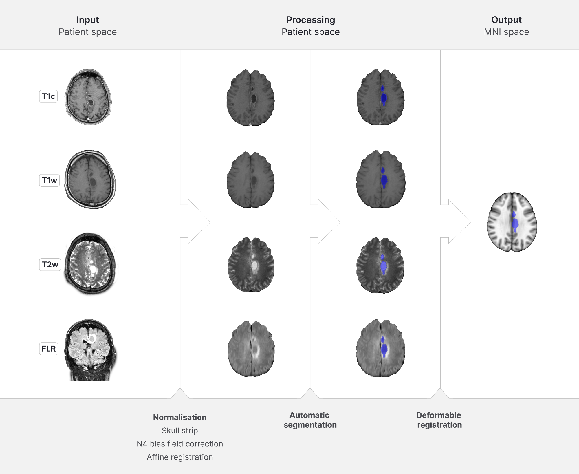MRI-pipeline van vier scanmodaliteiten via normalisatie, automatische segmentatie en deformable registration naar MNI-ruimte